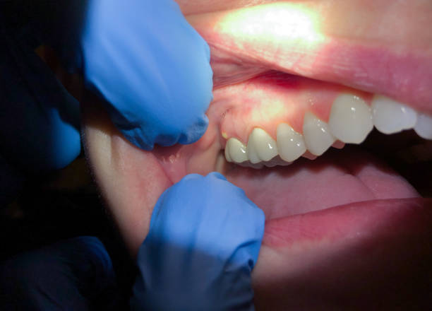 Best Broken or Chipped Tooth Repair in Sherwood Manor, CT